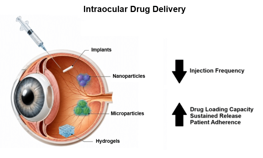 Intraocular drug delivery diagram